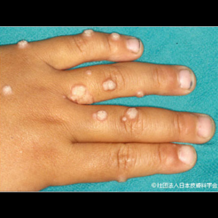 イボ ホクロの治療 長崎で皮膚のトラブル 美容は篠原皮膚科クリニック
